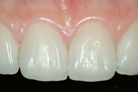 konya zirkonyum diş kaplama