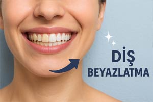 konya diş beyazlatma